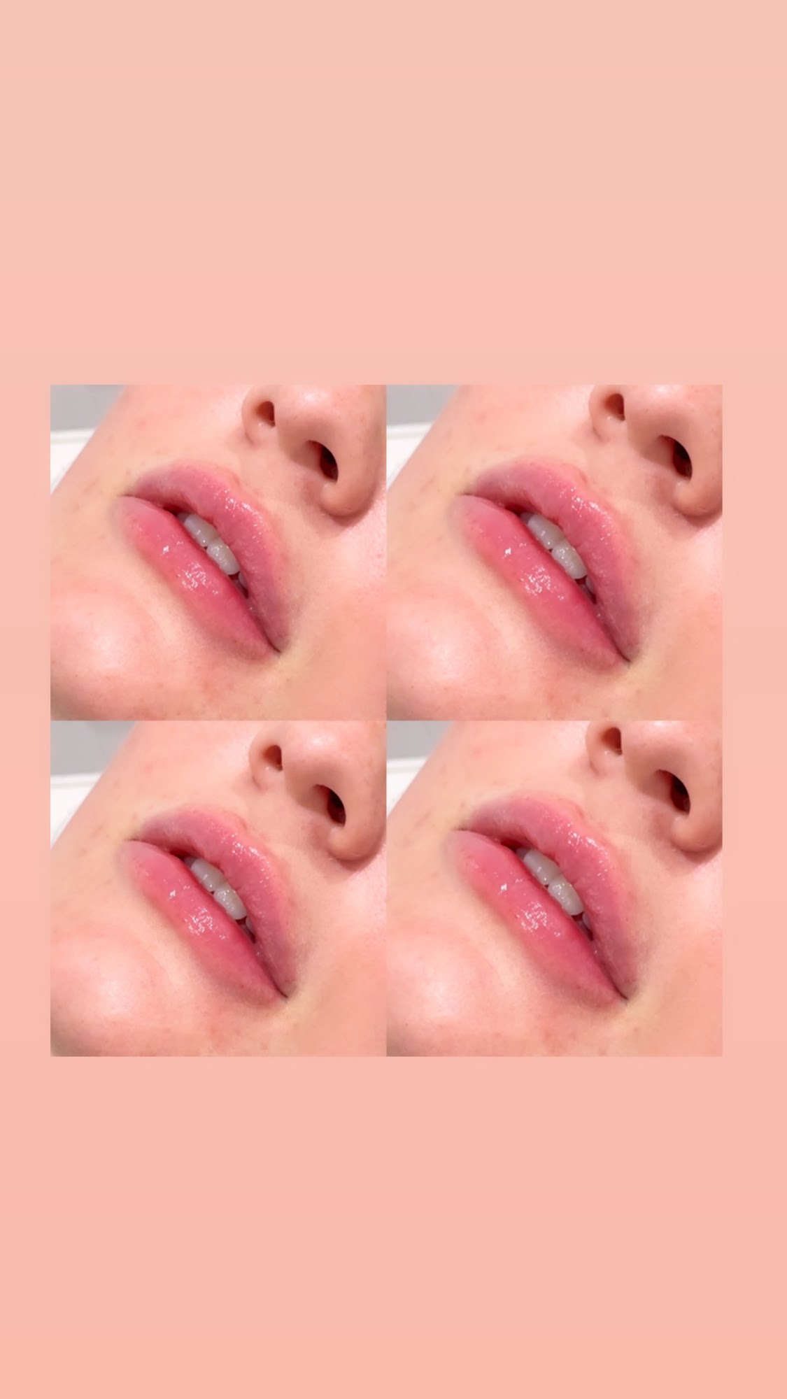 Lisas Beauty And Aesthetics | salon, Lip Fillers | Botox | Skin Boosters Wokingham