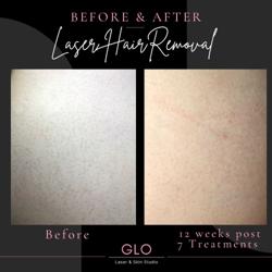GLO Laser & Skin Studio