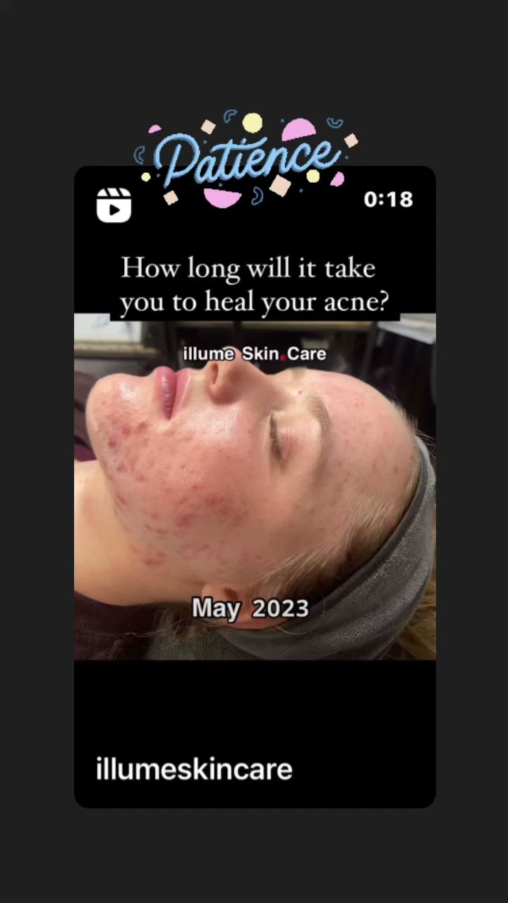 illume Skincare Acne and Age-Management Specialist